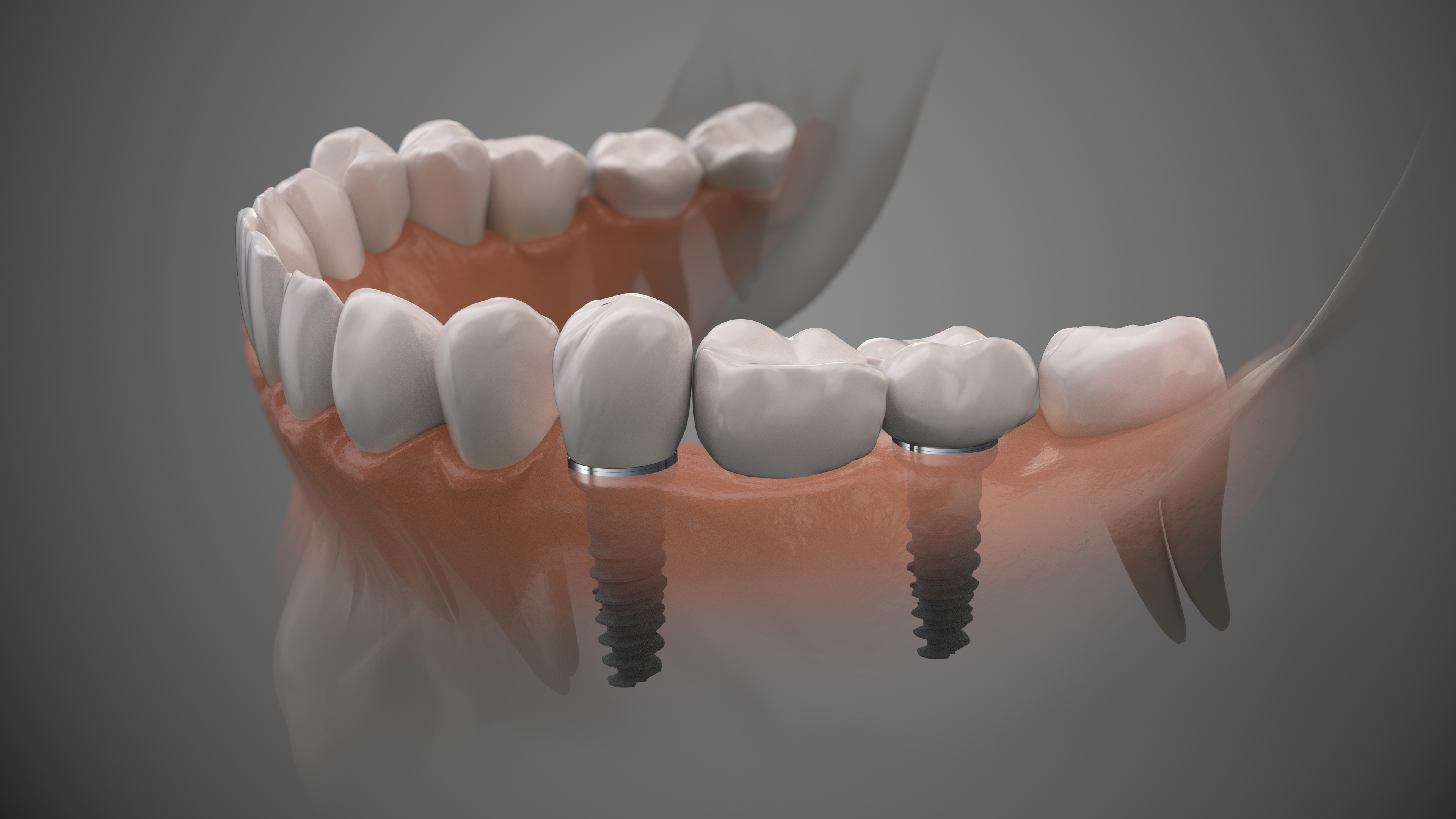Advanced dental implant technology